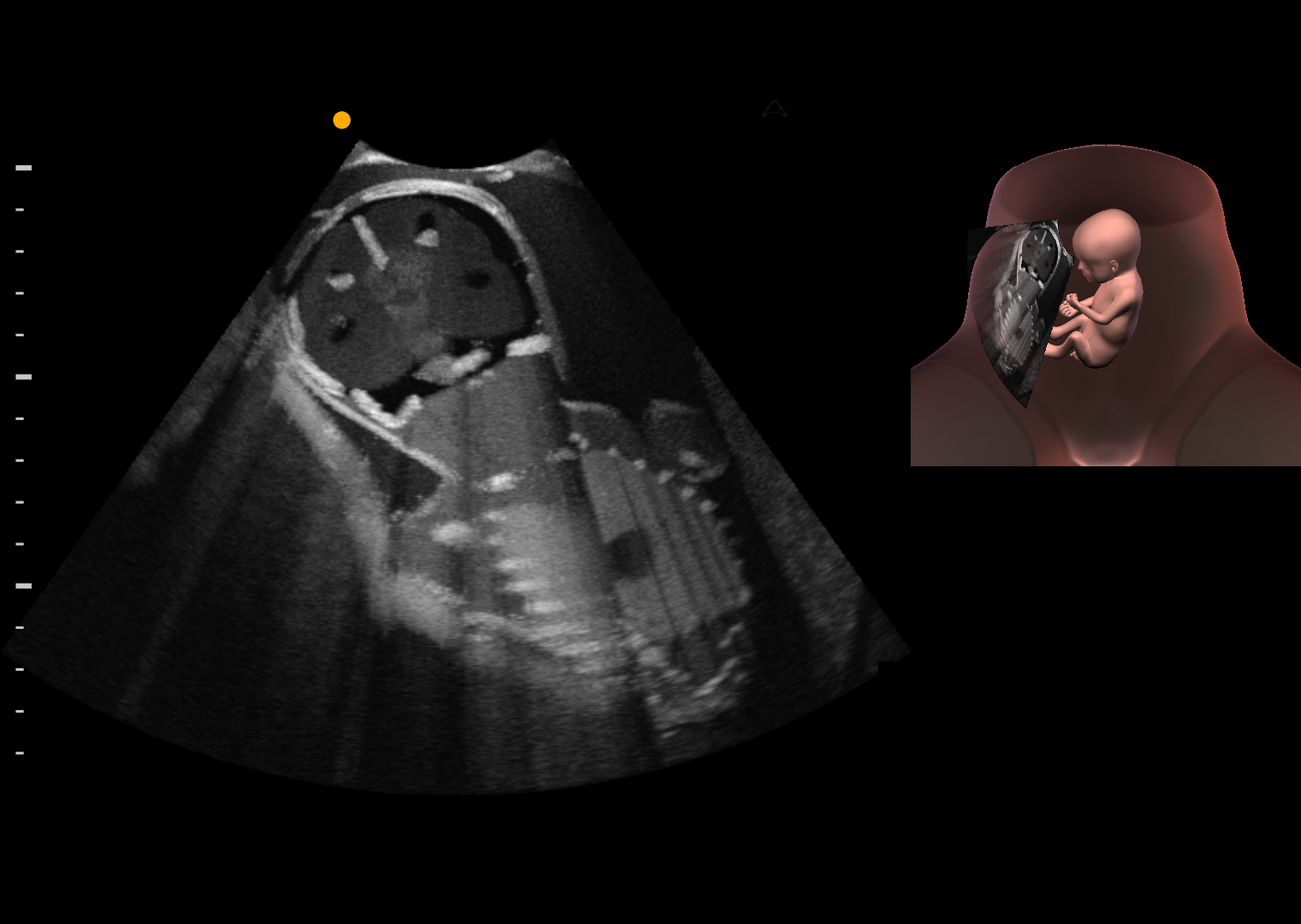 Fetal ultrasound image