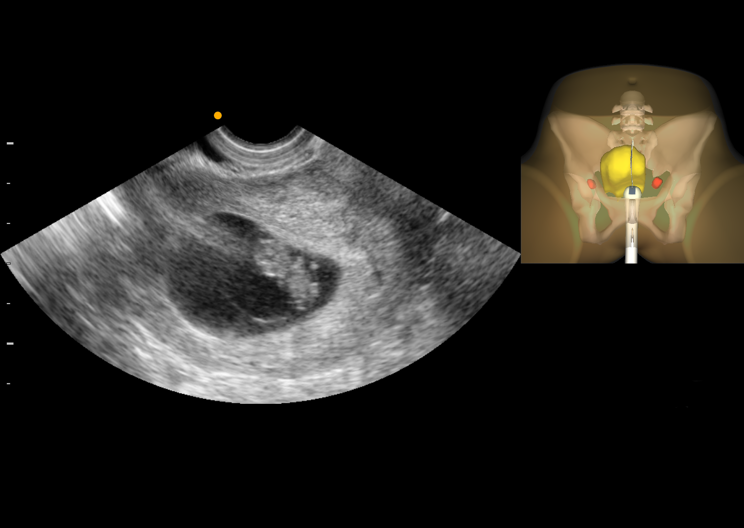 Transvaginal ultrasound image