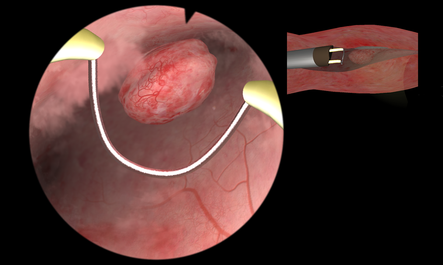 Hysteroscopy