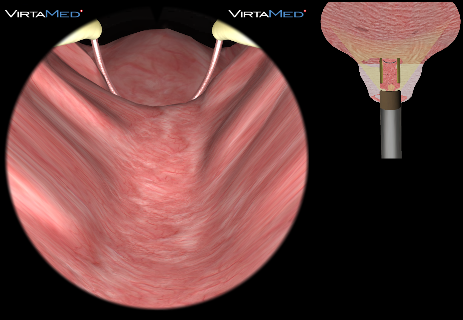 TURPSim_CompleteProcedures_Easy2_Screenshot2 cropped for web